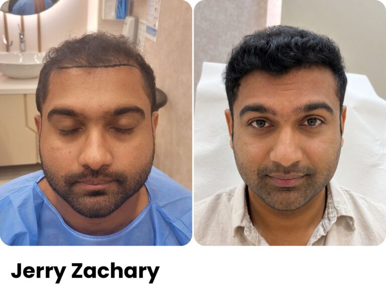 Jerry Zachary — Hair transplant before and after at Assure Clinic