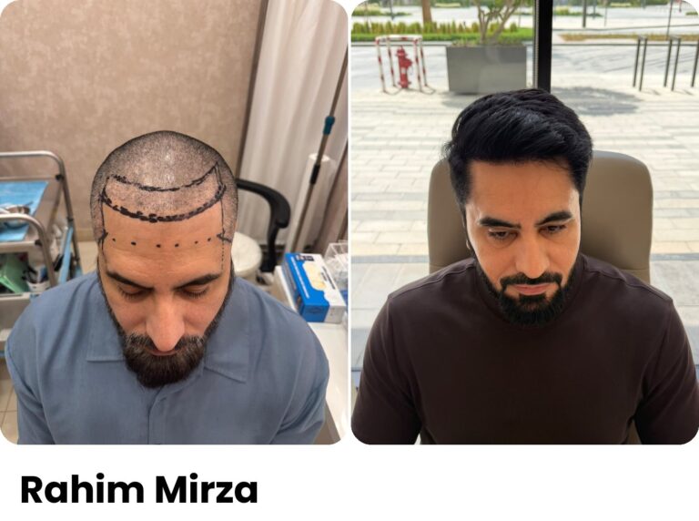 Rahim Mirza — Hair transplant before and after at Assure Clinic