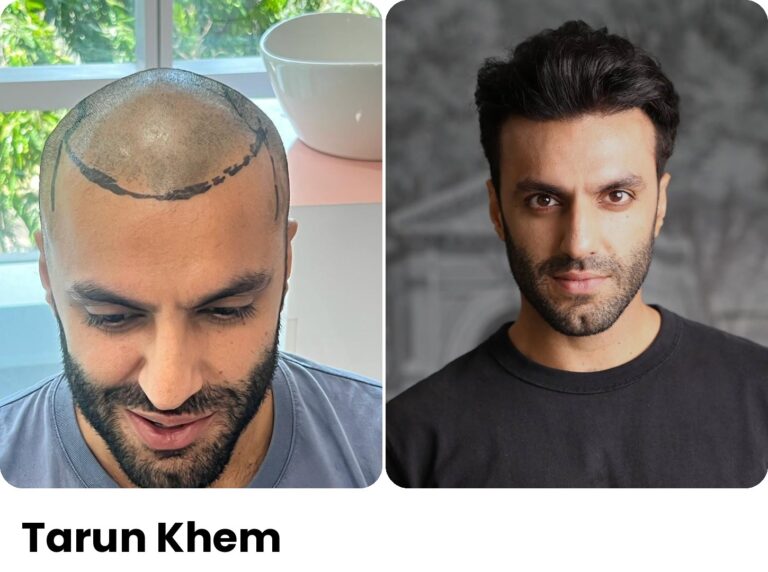 Tarun Khem — Hair transplant before and after at Assure Clinic
