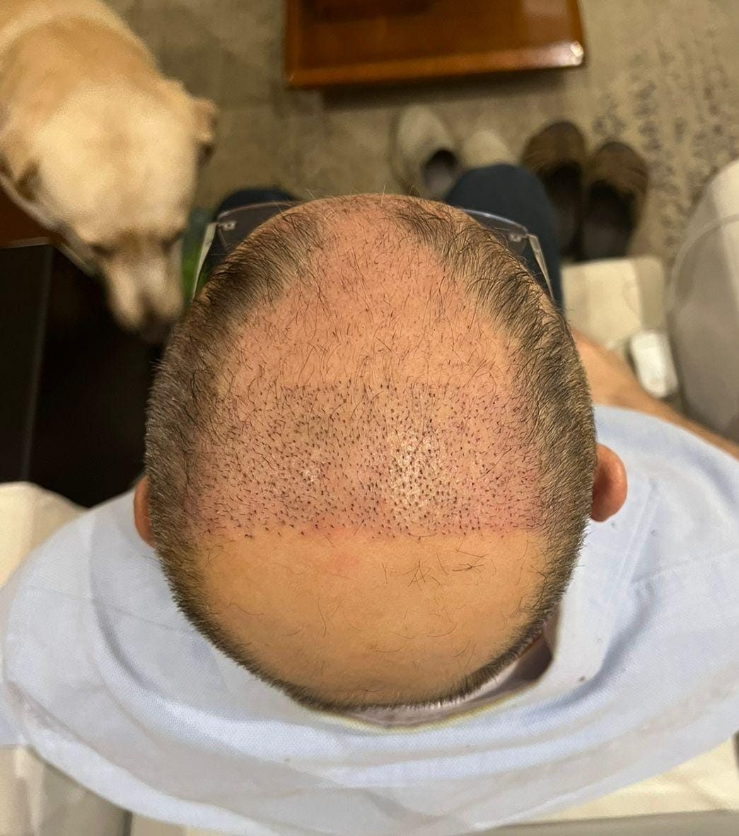 Burgis Daruwala — First Wash — hair transplant at Assure Clinic