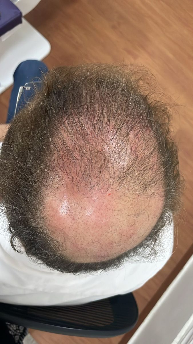 Burgis Daruwala — Early Regrowth — hair transplant at Assure Clinic