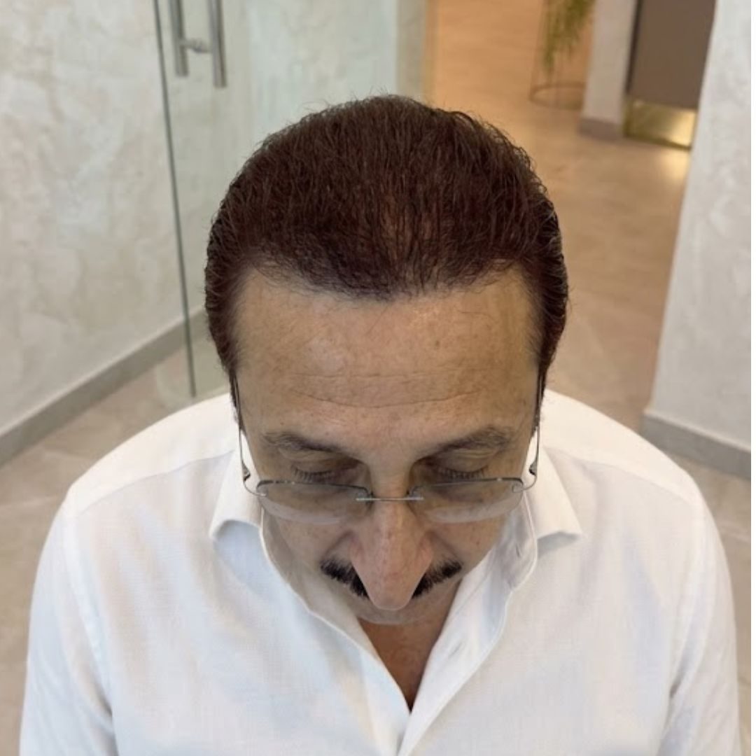 Burgis Daruwala after hair transplant at Assure Clinic