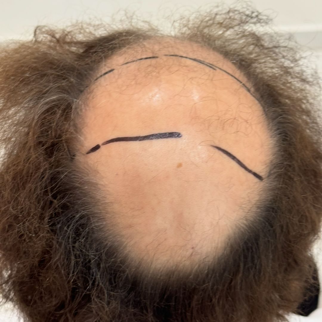 Burgis Daruwala — The Area to Treat — hair transplant at Assure Clinic