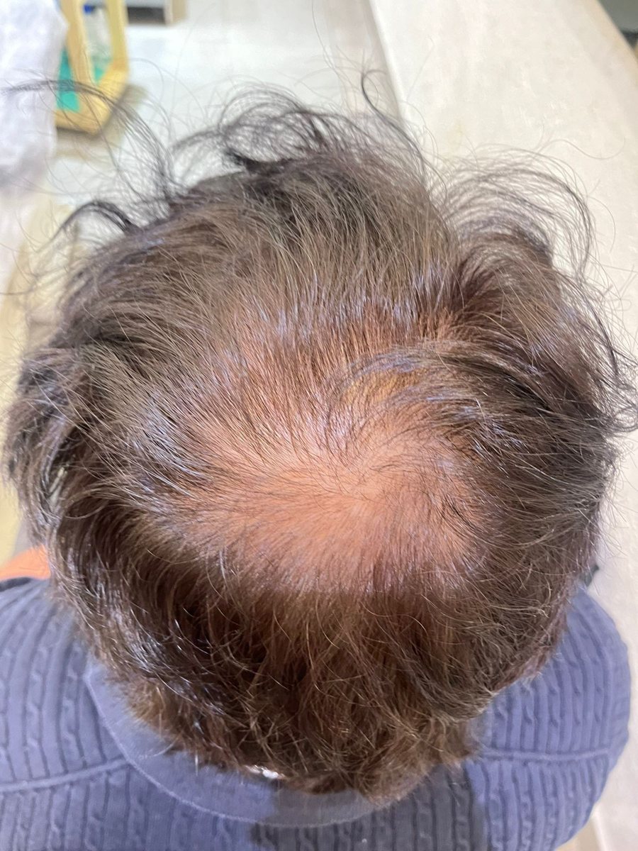 Chirag Mistry — Before: Crown — hair transplant at Assure Clinic