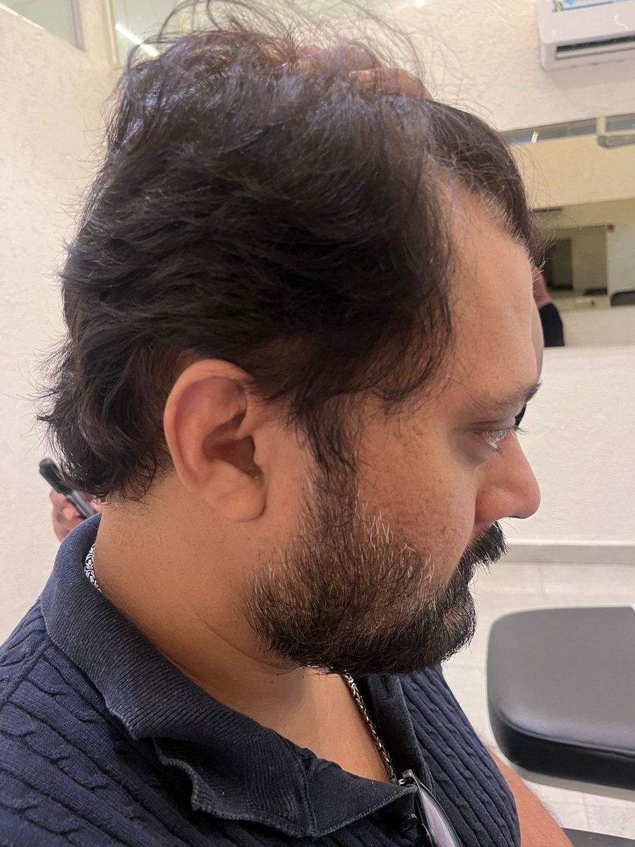 Chirag Mistry — Before: Side — hair transplant at Assure Clinic