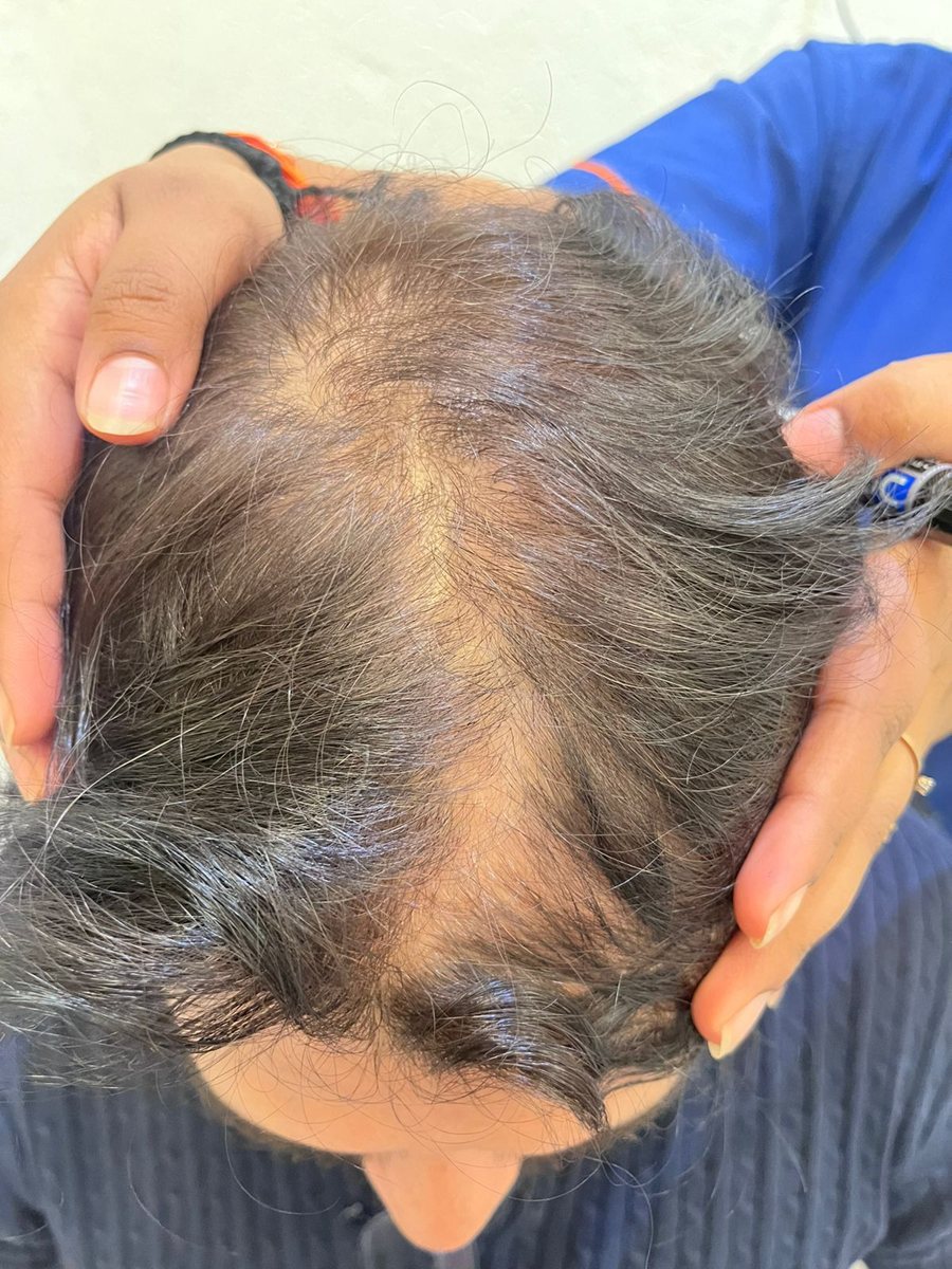 Chirag Mistry — Before: Top — hair transplant at Assure Clinic