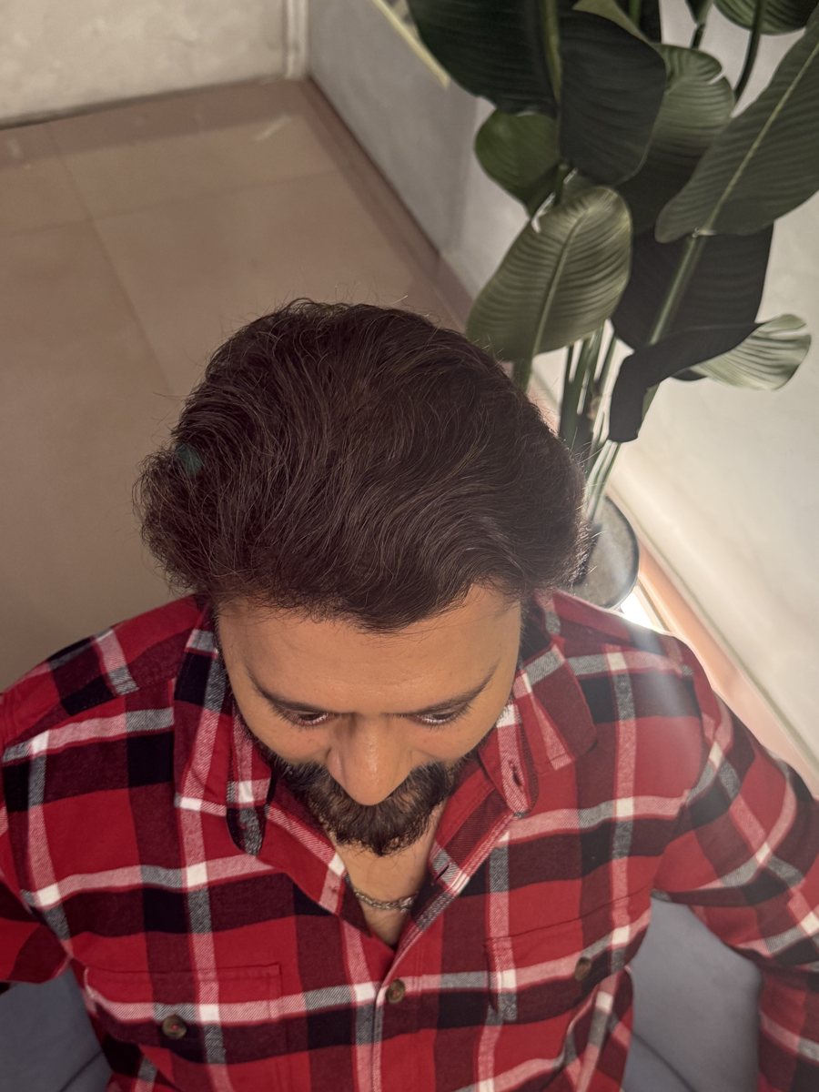 Chirag Mistry after hair transplant at Assure Clinic