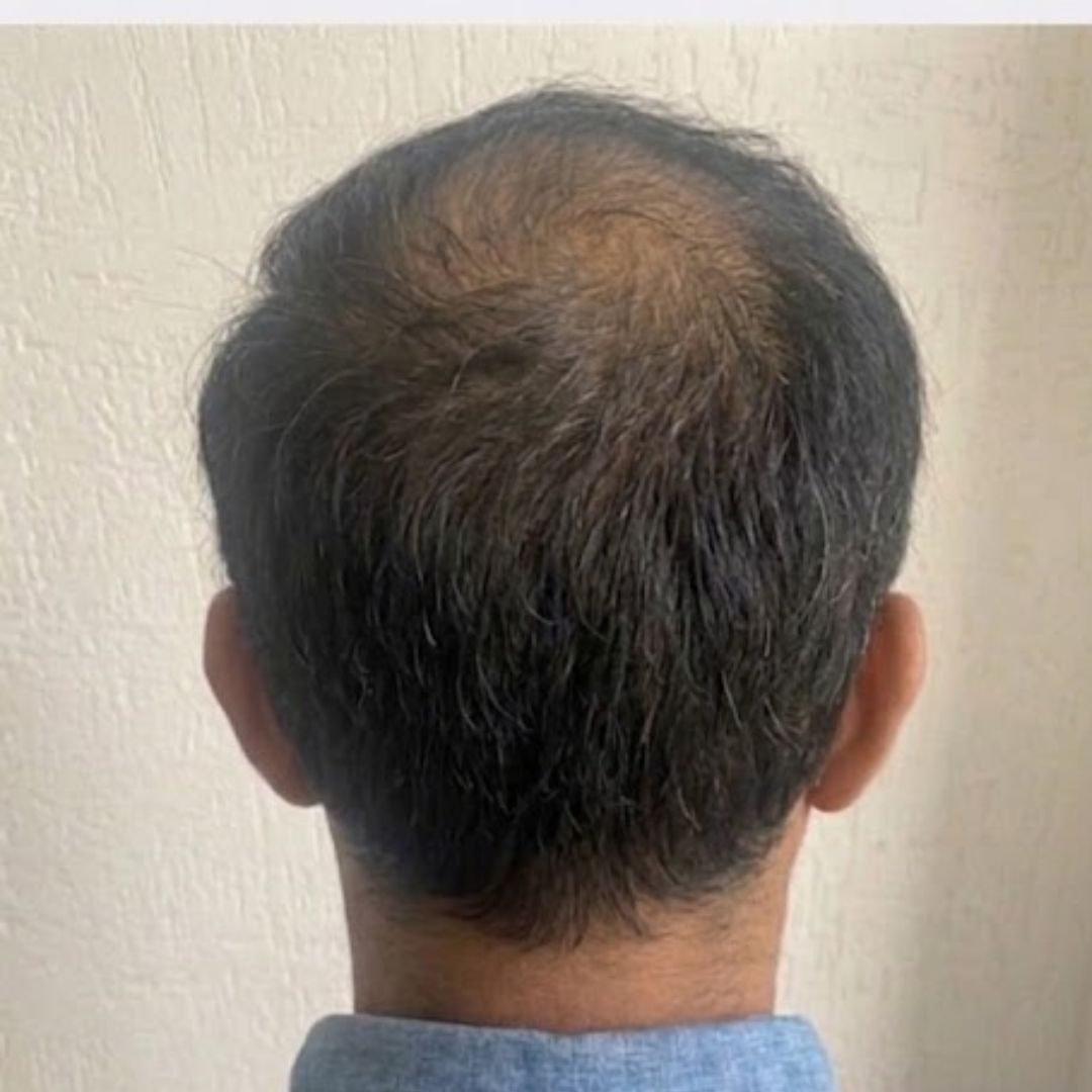 Hari Krishna — Before: Crown — hair transplant at Assure Clinic