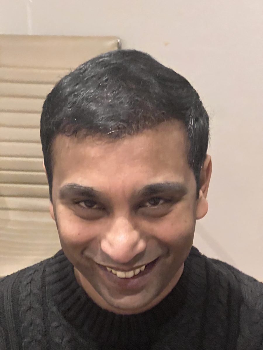 Hari Krishna — Six Months — hair transplant at Assure Clinic