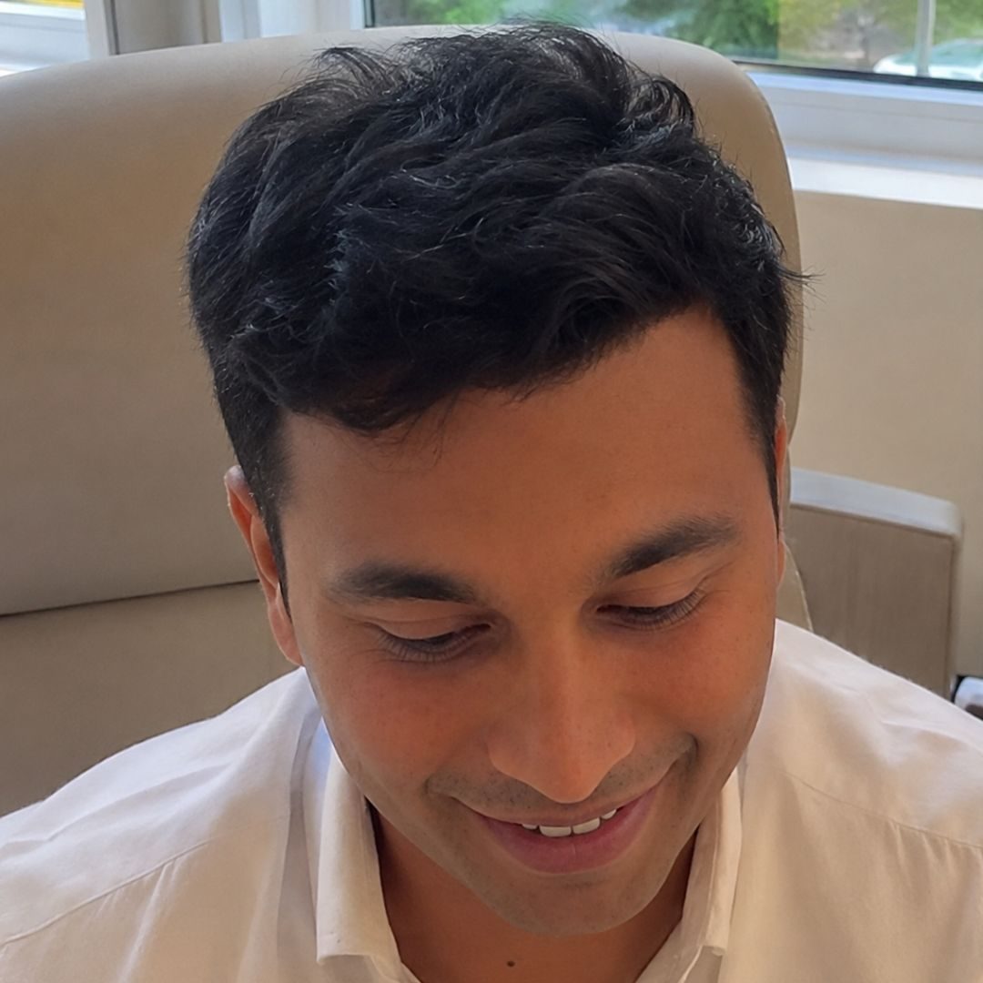 Hari Krishna after hair transplant at Assure Clinic