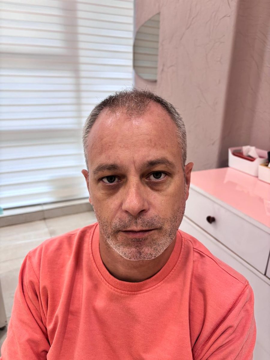 Julien before hair transplant