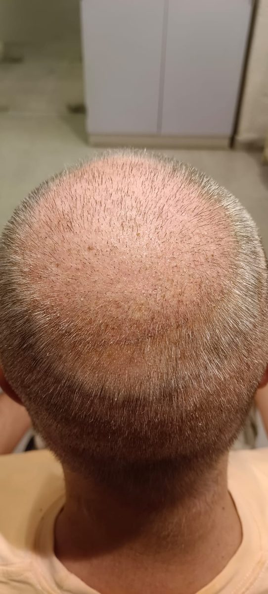 Julien — First Wash — hair transplant at Assure Clinic
