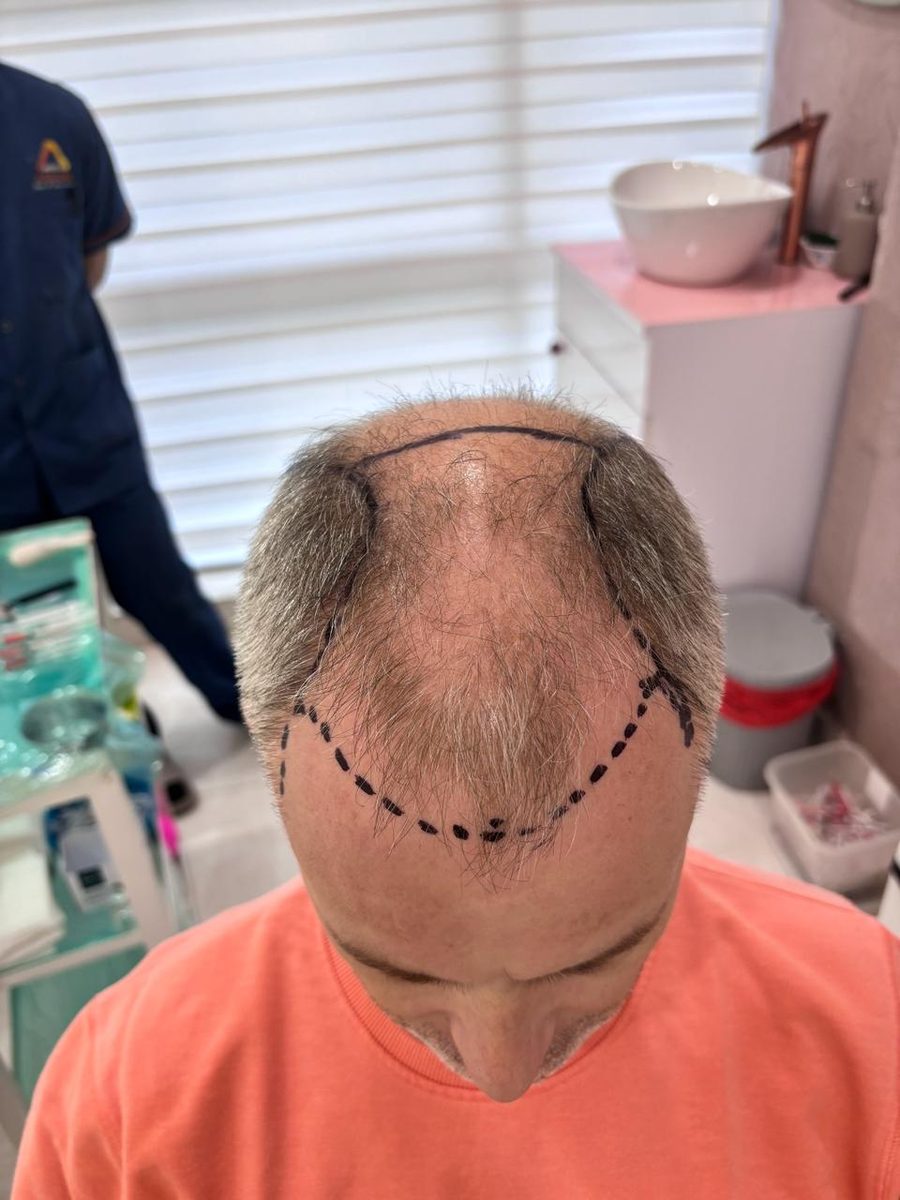 Julien — Area Design — hair transplant at Assure Clinic