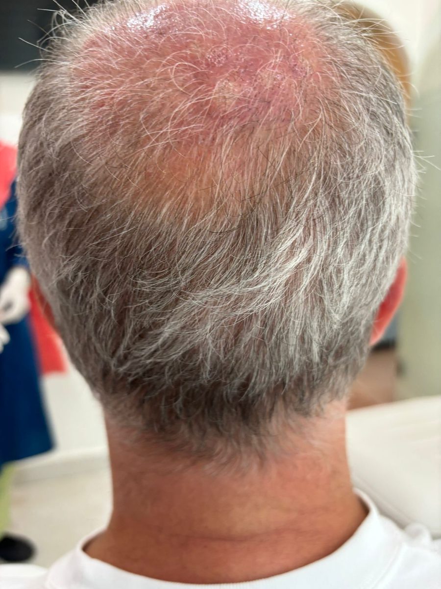 Julien — Early Regrowth — hair transplant at Assure Clinic