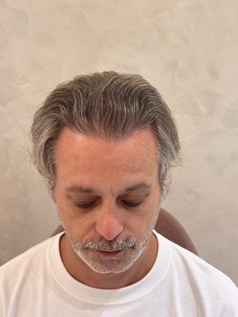 Julien after hair transplant at Assure Clinic