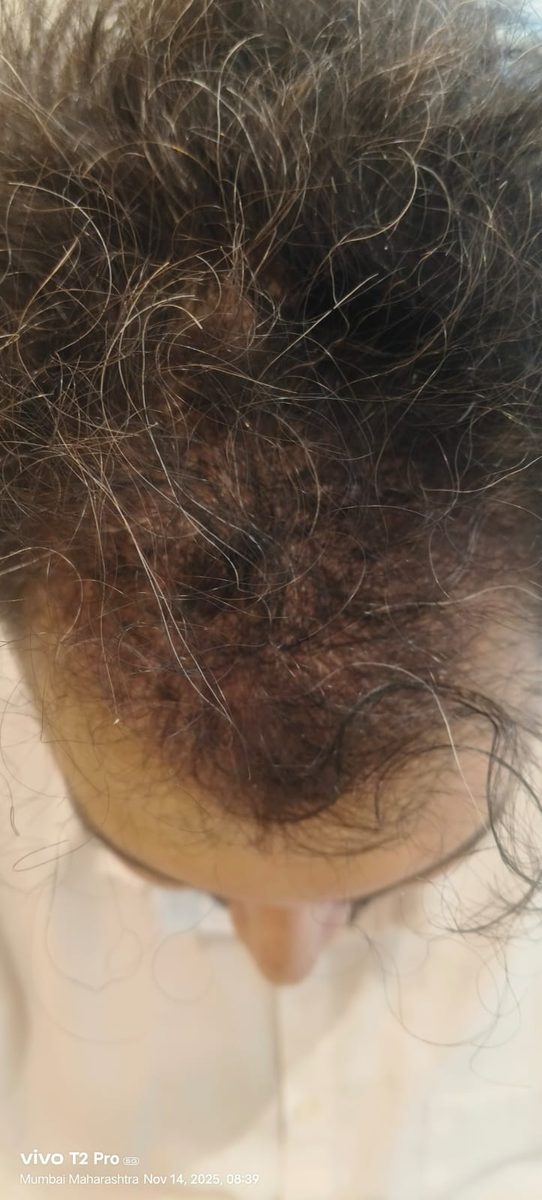 Kuvam Dutta — First Wash — hair transplant at Assure Clinic