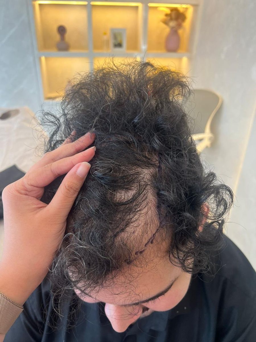 Kuvam Dutta — Hairline Design — hair transplant at Assure Clinic