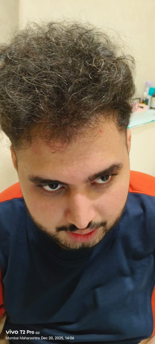 Kuvam Dutta — Early Days — hair transplant at Assure Clinic