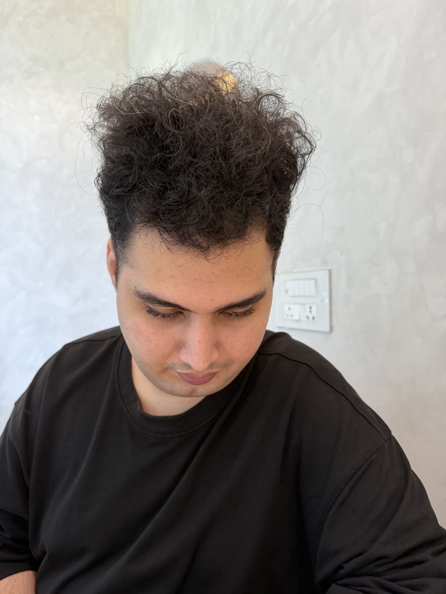 Kuvam Dutta after hair transplant at Assure Clinic