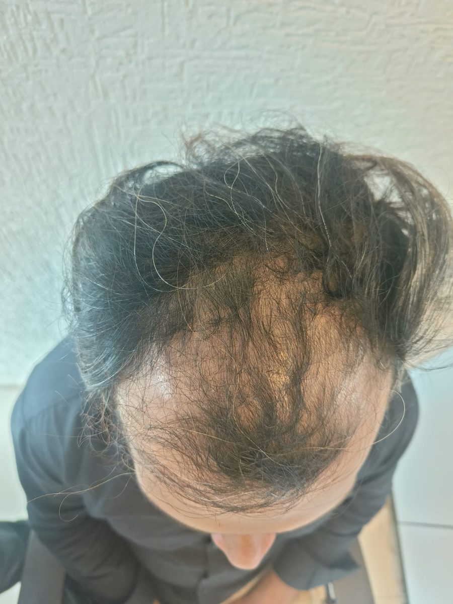 Mihir Sharma — Before: Top — hair transplant at Assure Clinic