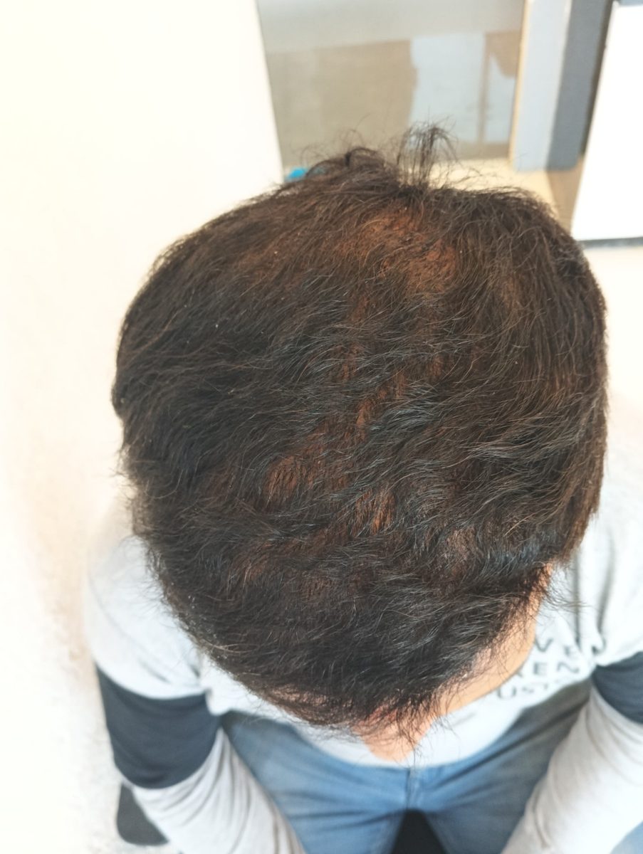 Mihir Sharma — Five Months: Crown — hair transplant at Assure Clinic