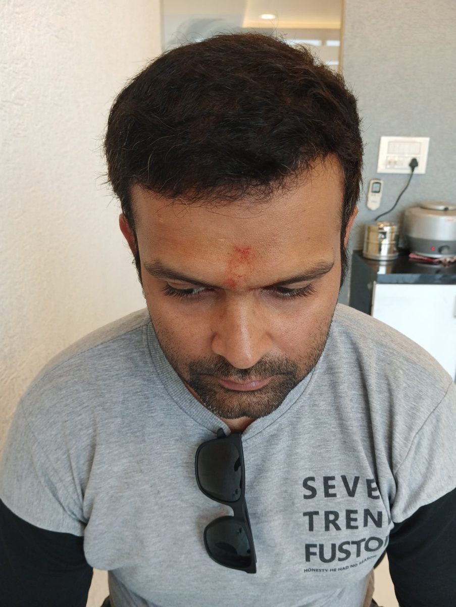 Mihir Sharma — Five Months: Front — hair transplant at Assure Clinic