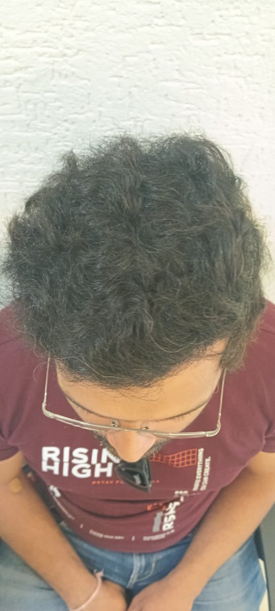 Mihir Sharma after hair transplant at Assure Clinic