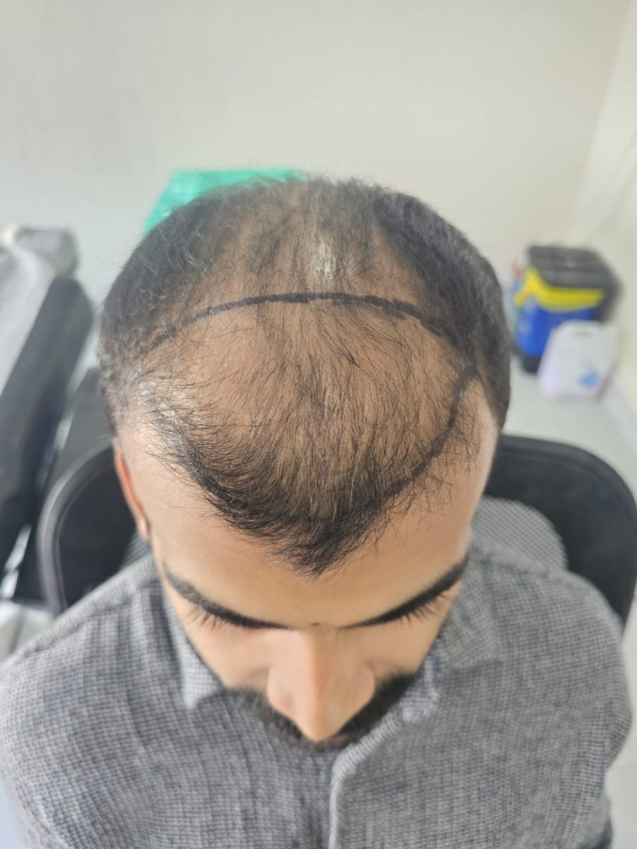 Nikhil Nair — Hairline Design — hair transplant at Assure Clinic