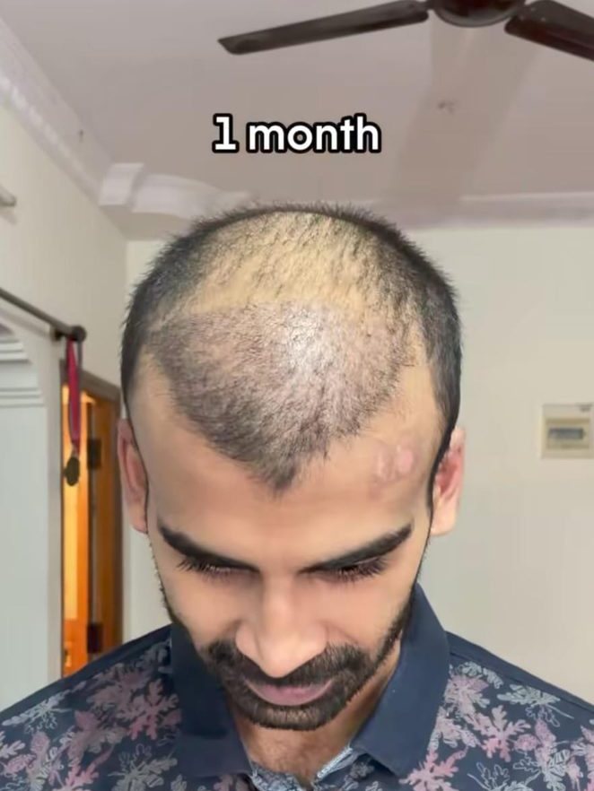 Nikhil Nair — The Shedding Phase — hair transplant at Assure Clinic