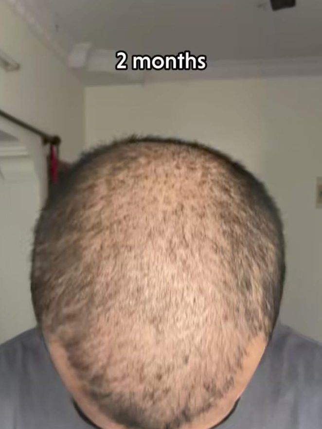 Nikhil Nair — Still Thin — hair transplant at Assure Clinic