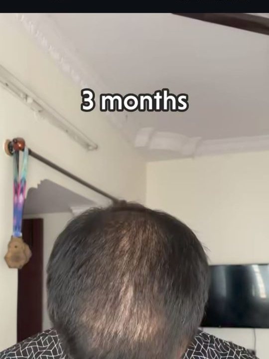Hair transplant month 3 — documented Assure Clinic patient