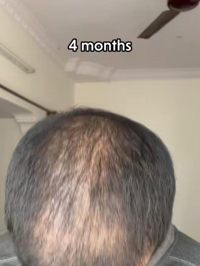 Hair transplant month 4 — documented Assure Clinic patient
