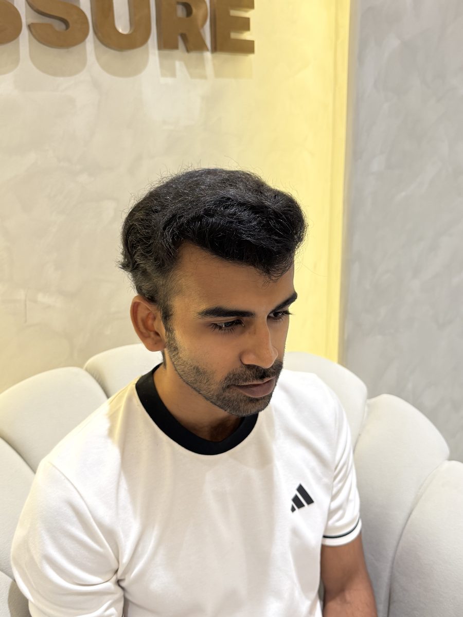 Nikhil Nair after hair transplant at Assure Clinic