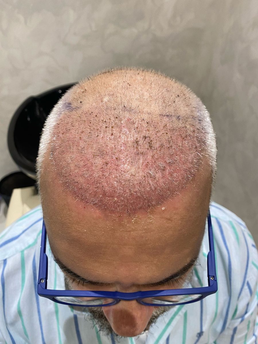 Praveen Changlani — First Wash — hair transplant at Assure Clinic
