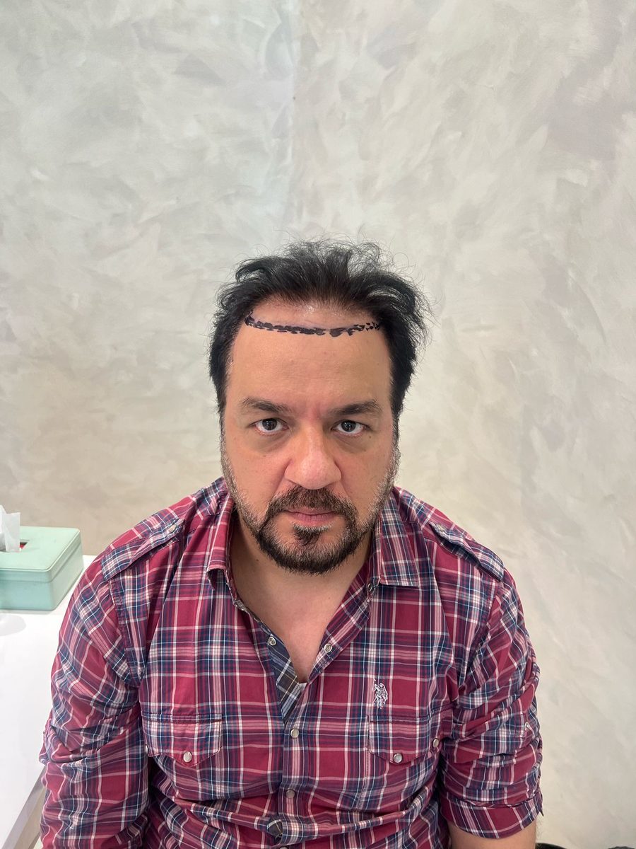 Praveen Changlani — Hairline Design — hair transplant at Assure Clinic