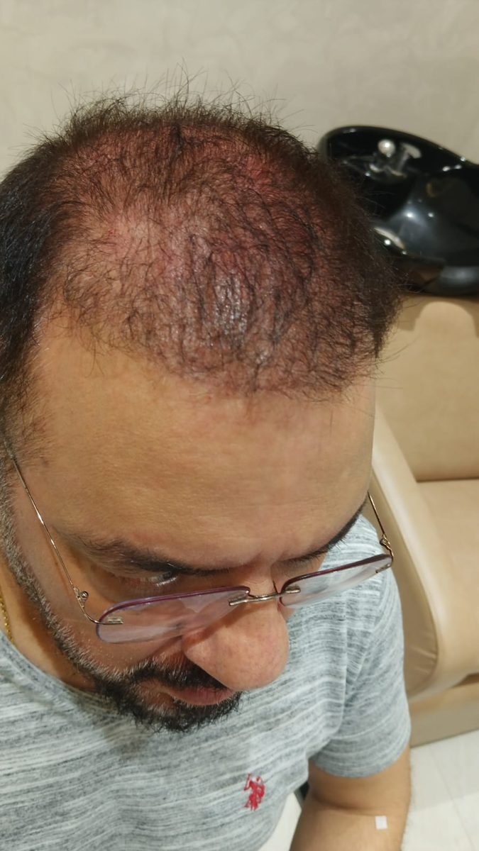 Praveen Changlani — Early Days — hair transplant at Assure Clinic