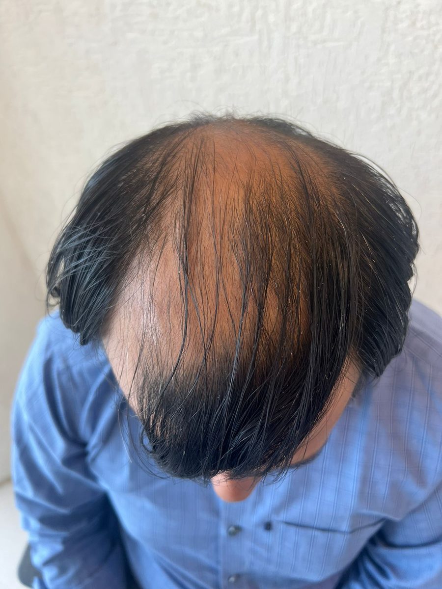 Rahul Jain — Before: Top — hair transplant at Assure Clinic