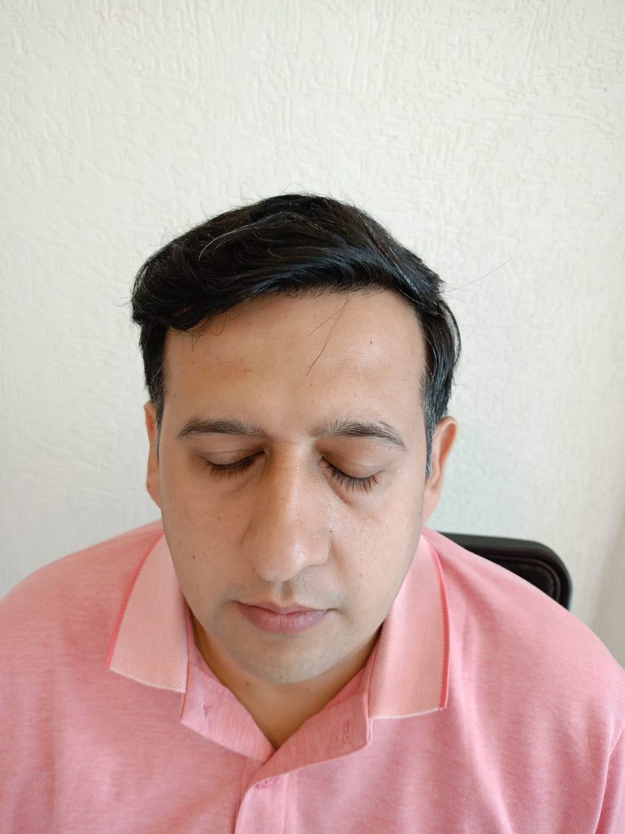 Rahul Jain — Six Months — hair transplant at Assure Clinic