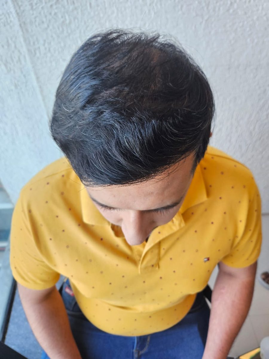 Rahul Jain after hair transplant at Assure Clinic