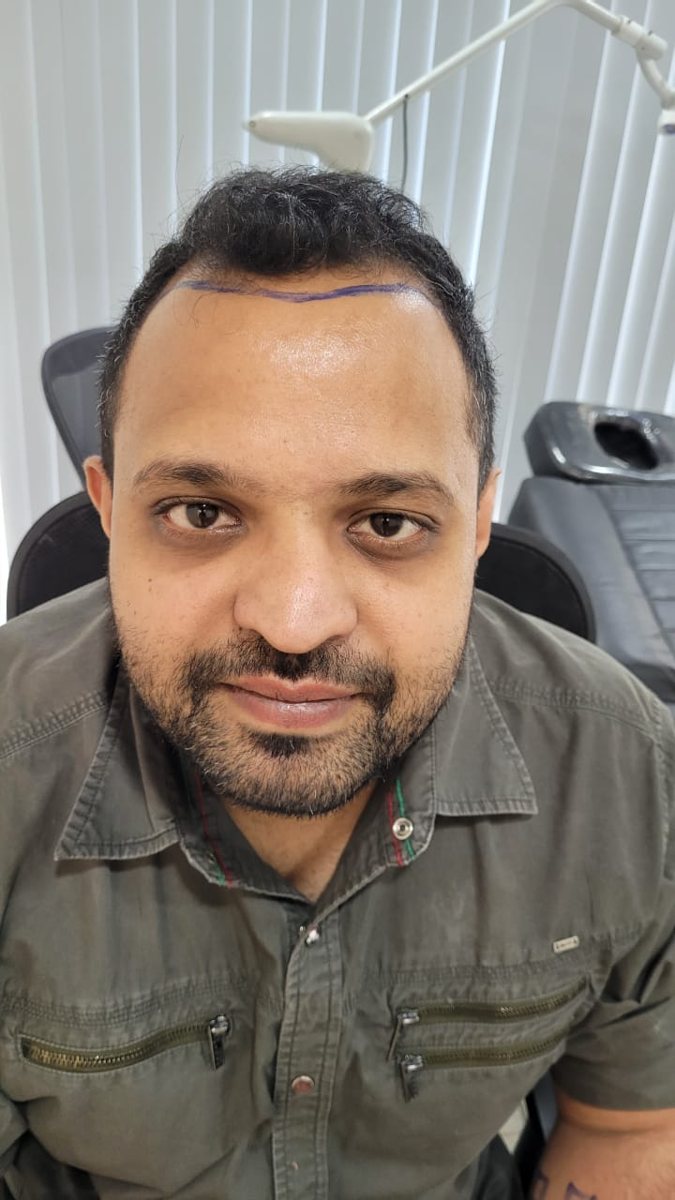 Hair transplant result before — documented Assure Clinic patient journey
