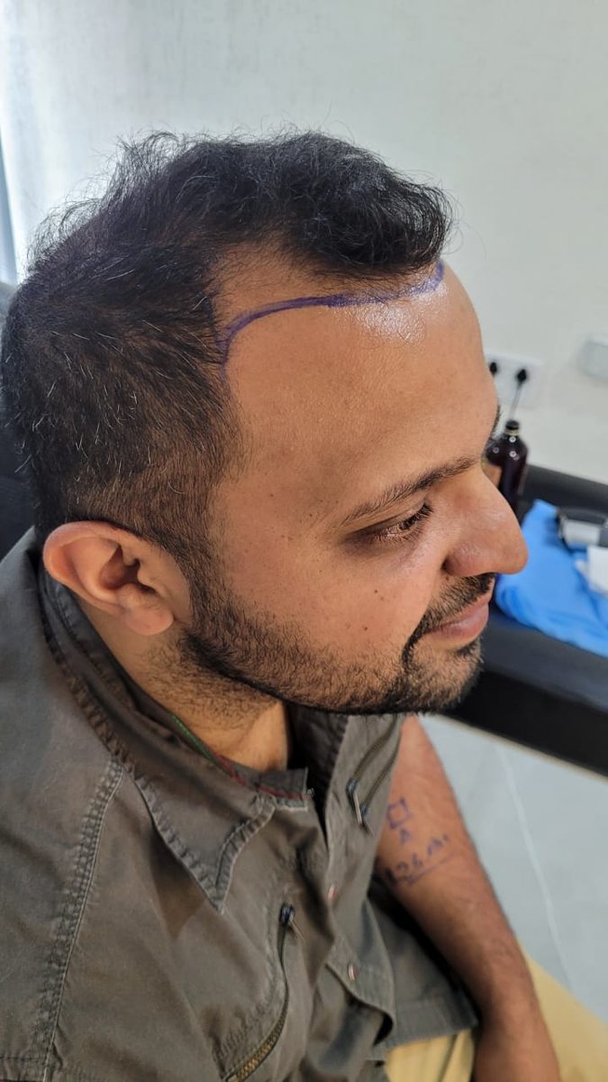 Roshan Shetty — The Hairline from the Side — hair transplant at Assure Clinic