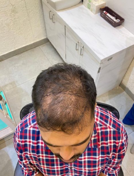 Siddhesh Tendle — Before: Top — hair transplant at Assure Clinic