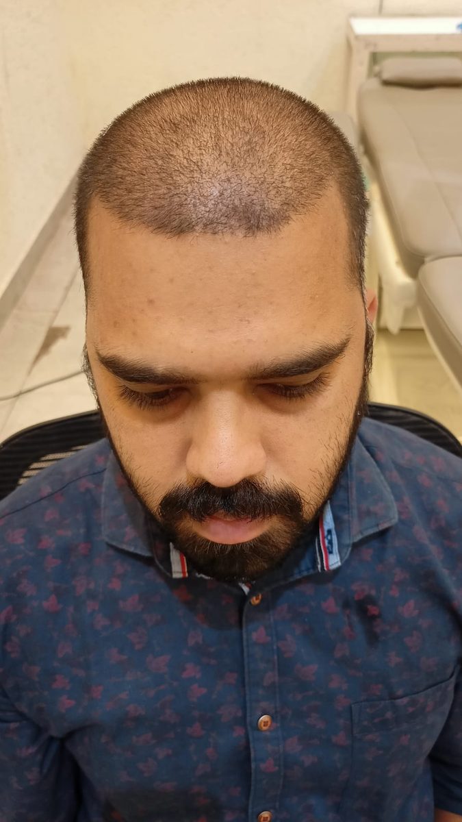 Siddhesh Tendle — First Wash — hair transplant at Assure Clinic