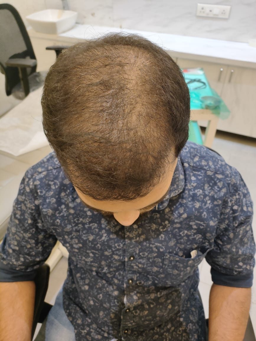 Siddhesh Tendle — Early Regrowth: Top — hair transplant at Assure Clinic