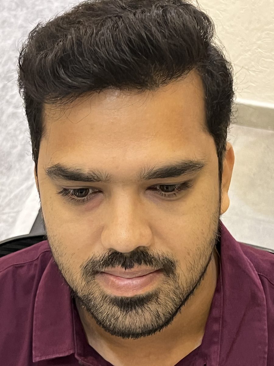 Siddhesh Tendle after hair transplant at Assure Clinic