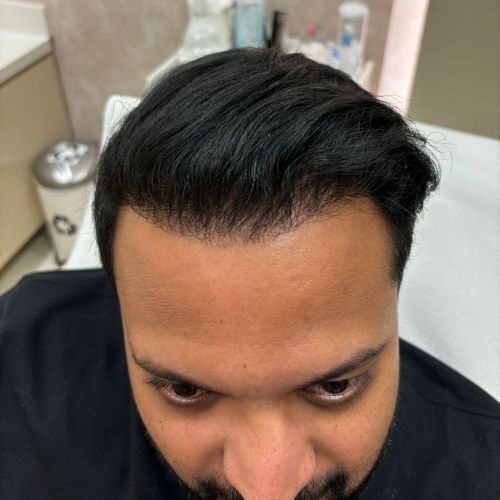 Hair Transplant After 10 months