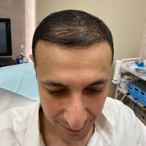 Raymond Shroff: Five Months into Hair Treatment