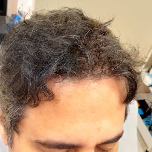 Rupinder Rekh: 6 Months into Hair Treatment