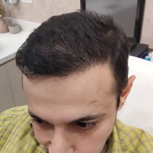 Raymond Shroff: 6 Months into Hair Treatment
