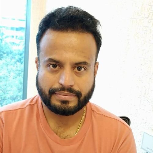 Ketan Tilve: 8 Months into Hair Treatment